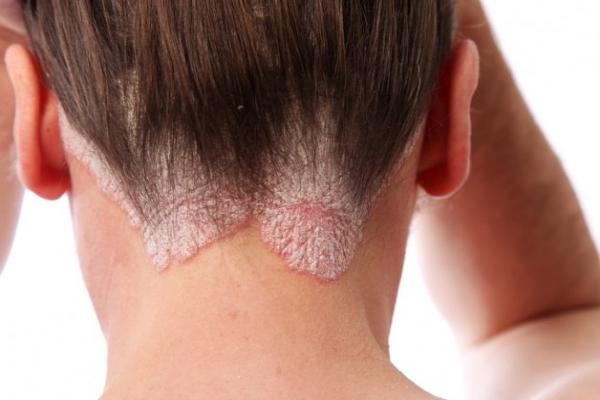 درمان اگزما